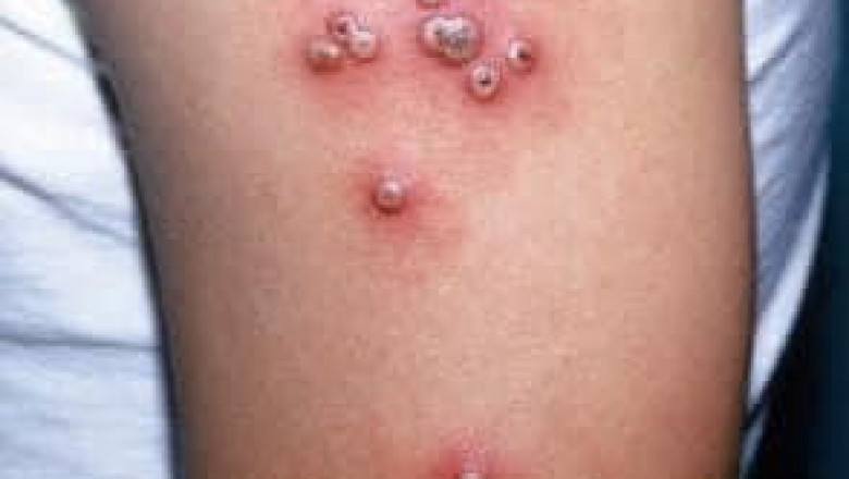 Hulga sa monkey pox sa Pilipinas, nagpabiling ubos; publiko gipaamping