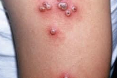 Hulga sa monkey pox sa Pilipinas, nagpabiling ubos; publiko gipaamping