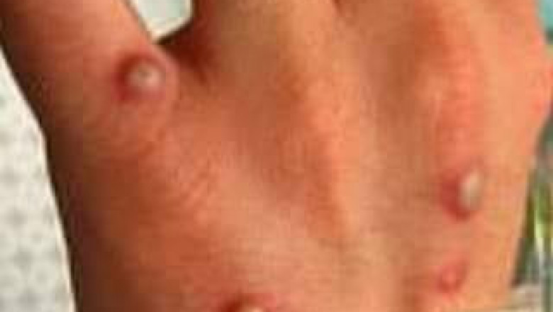 DOH confirms first case of Monkeypox in PH