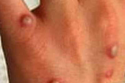 DOH confirms first case of Monkeypox in PH