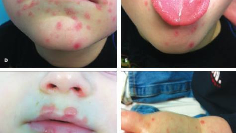 HFMD  infects over 1,000 kids in Iloilo